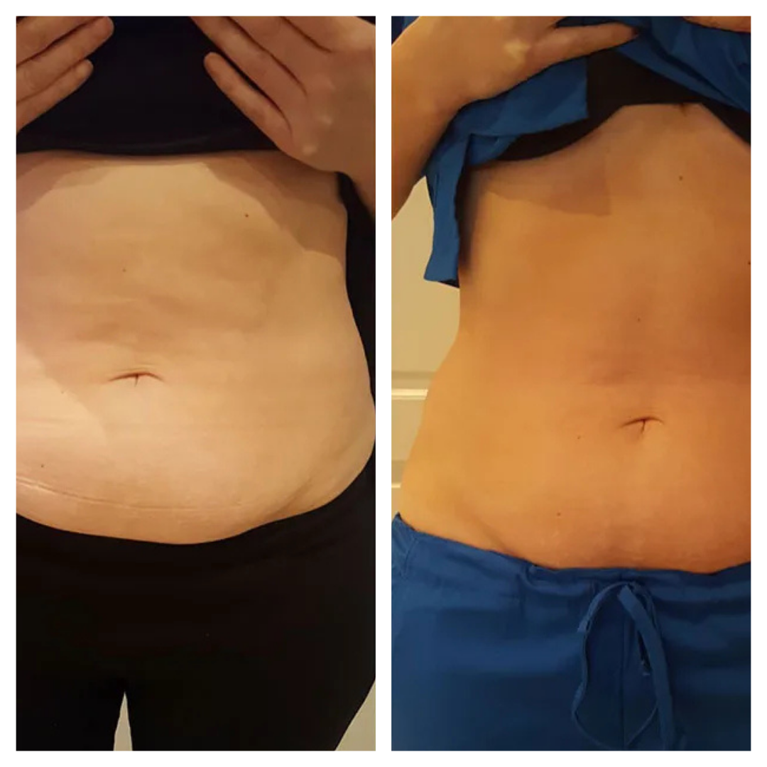 Sorelux Red Light Therapy Belt