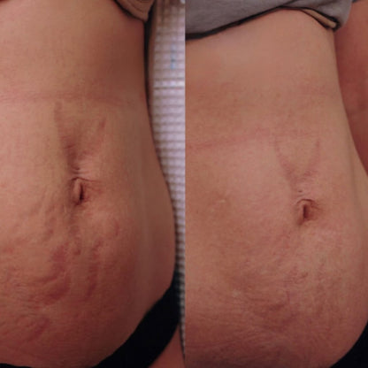 Sorelux Red Light Therapy Belt